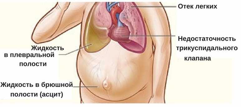 Жидкость в брюшной полости при онкологии