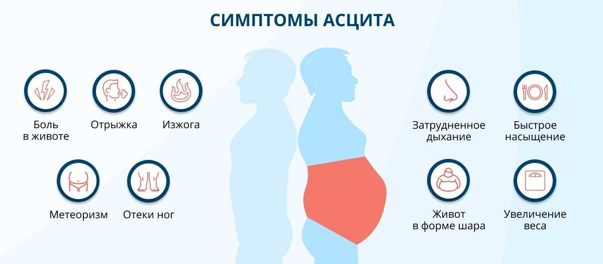 Асцит: что это такое, причины, симптомы водянки живота, лечение асцита брюшной полости, сколько живут | клиники «евроонко»